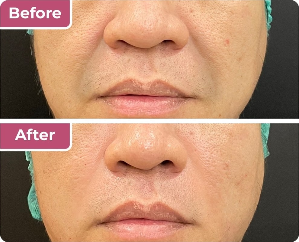 Sebelum dan sesudah filler smiling line di Bella Derma Aesthetic