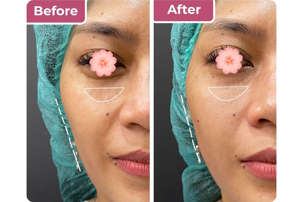 Tindakan collagen stimulator di Bella Derma Aesthetic